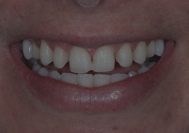 antes